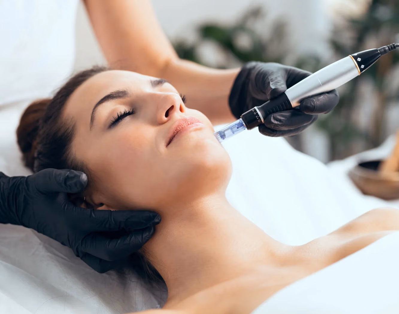 Microneedling
